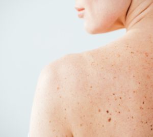 Google: con intelligenza artificiale è possibile supportare il check up della pelle