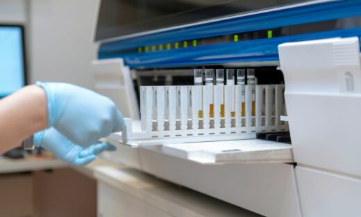 Tumore alle ovaie: verso un test delle urine per la diagnosi precoce