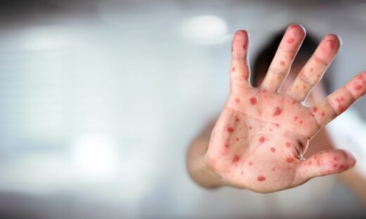 Morbillo in Italia: è di nuovo epidemia