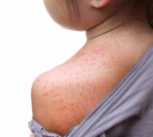 Morbillo: Iss preoccupata per la ripartenza dei casi