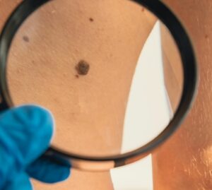 Melanoma: casi aumentati del 30%. Ma si sopravvive di più