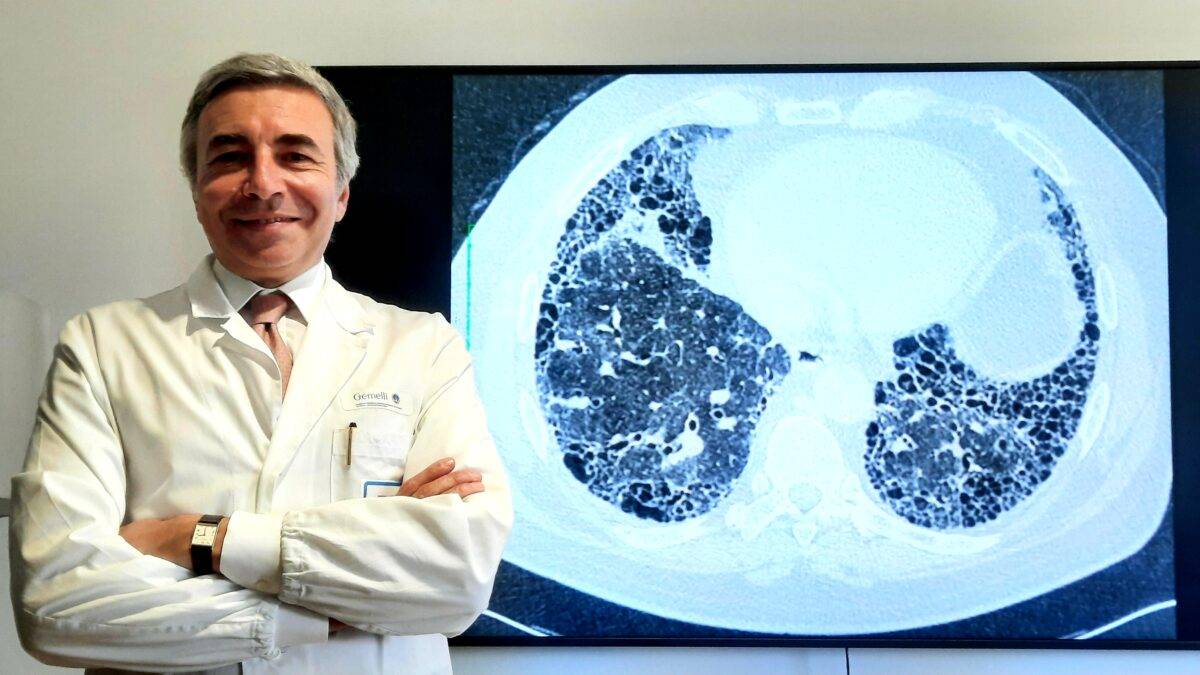 Fibrosi polmonare: in arrivo un farmaco che funziona