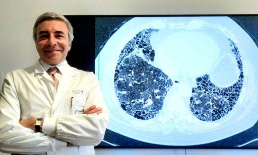 Fibrosi polmonare: in arrivo un farmaco che funziona