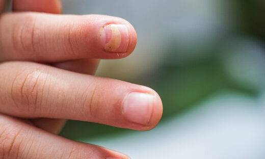 Quanto siamo stressati? Ce lo possono dire le unghie