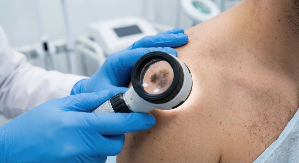 melanoma