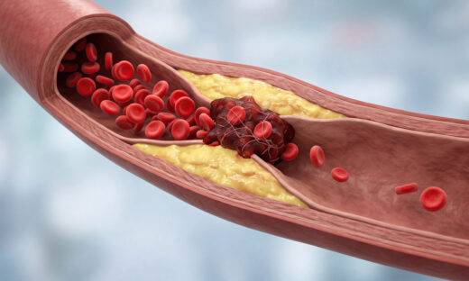 Più microplastiche nel sangue di chi ha un infarto